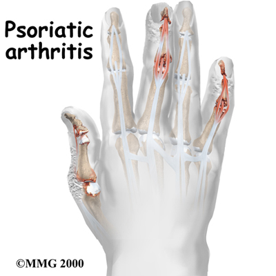 Download this What Psoriatic Arthritis picture