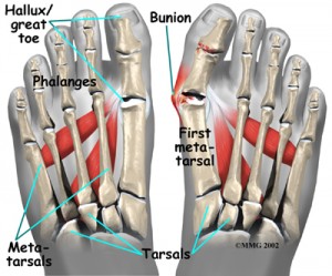 Bunion Removal (Bunionectomy) Surgery & Recovery time