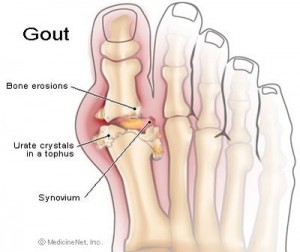 Gout - Anatomy of Feet