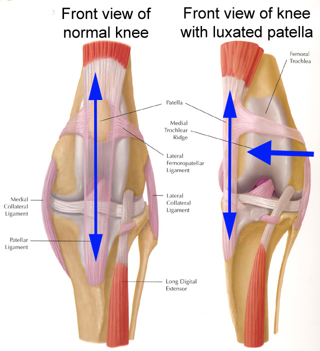 Kneecap Dislocation (Patellar Subluxation) Treatment, Symptom & Causes