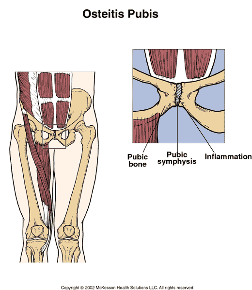 Osteitis Pubis (Pubic Symphysis Dysfunction) Treatment & Causes