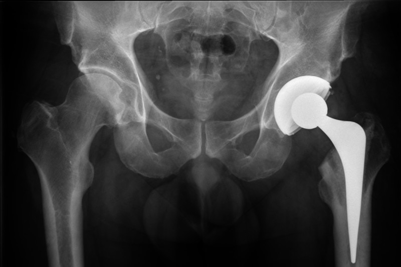 hip joint x-ray