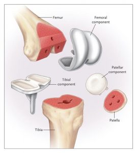 required elements in knee arthroplasty