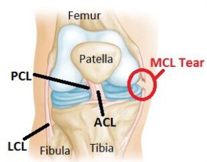 Ligament Injuries Sydney, NSW, ACL, MCL, PCL Tear Randwick