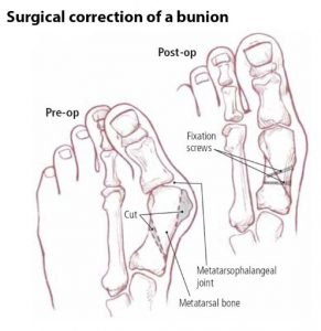 surgery option for bunion