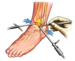 lateral collateral ligaments surgery