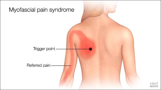 example trigger point and referred pain