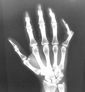 X-ray of dislocated finger bone