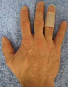 treating dislocated finger